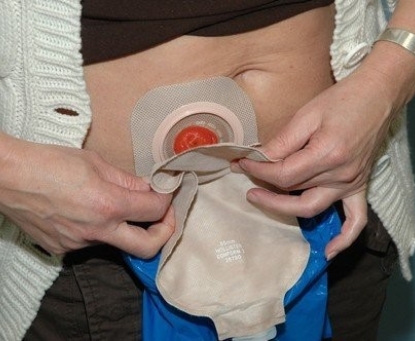 Vì sao bệnh nhân ung thư trực tràng thường phải mang hậu môn nhân tạo